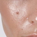 OILY SKIN