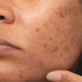 PIGMENT SPOTS