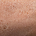 DRY SKIN, ADULT SKIN